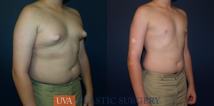 Male Breast Reduction (Gynecomastia) Case 65 Before & After View #2 | Richmond, Charlottesville & Roanoke, VA | University of Virginia Plastic Surgery