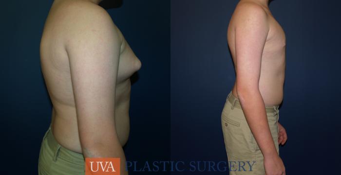 Male Breast Reduction (Gynecomastia) Case 65 Before & After View #3 | Richmond, Charlottesville & Roanoke, VA | University of Virginia Plastic Surgery