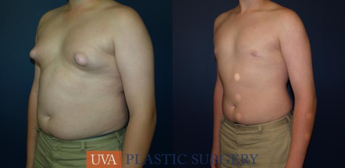 Male Breast Reduction (Gynecomastia) Case 65 Before & After View #4 | Richmond, Charlottesville & Roanoke, VA | University of Virginia Plastic Surgery