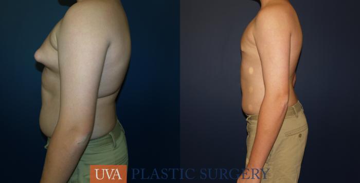 Male Breast Reduction (Gynecomastia) Case 65 Before & After View #5 | Richmond, Charlottesville & Roanoke, VA | University of Virginia Plastic Surgery