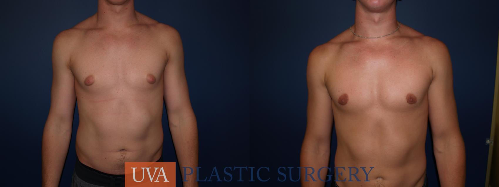 Male Breast Reduction (Gynecomastia) Case 77 Before & After View #1 | Charlottesville & Fishersville, VA | University of Virginia Plastic Surgery