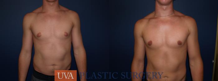 Male Breast Reduction (Gynecomastia) Case 77 Before & After View #1 | Richmond, Charlottesville & Roanoke, VA | University of Virginia Plastic Surgery