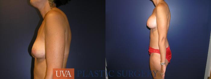 Mommy Makeover Case 16 Before & After View #5 | Richmond, Charlottesville & Roanoke, VA | University of Virginia Plastic Surgery