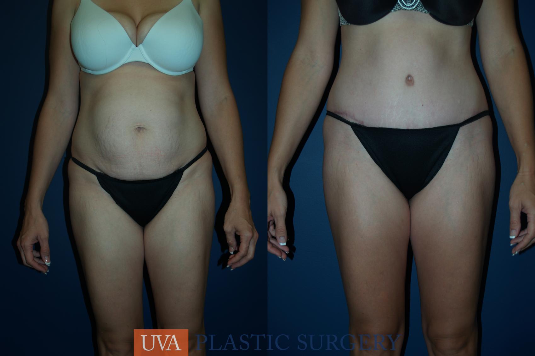 Mommy Makeover Case 42 Before & After View #1 | Charlottesville & Fishersville, VA | University of Virginia Plastic Surgery