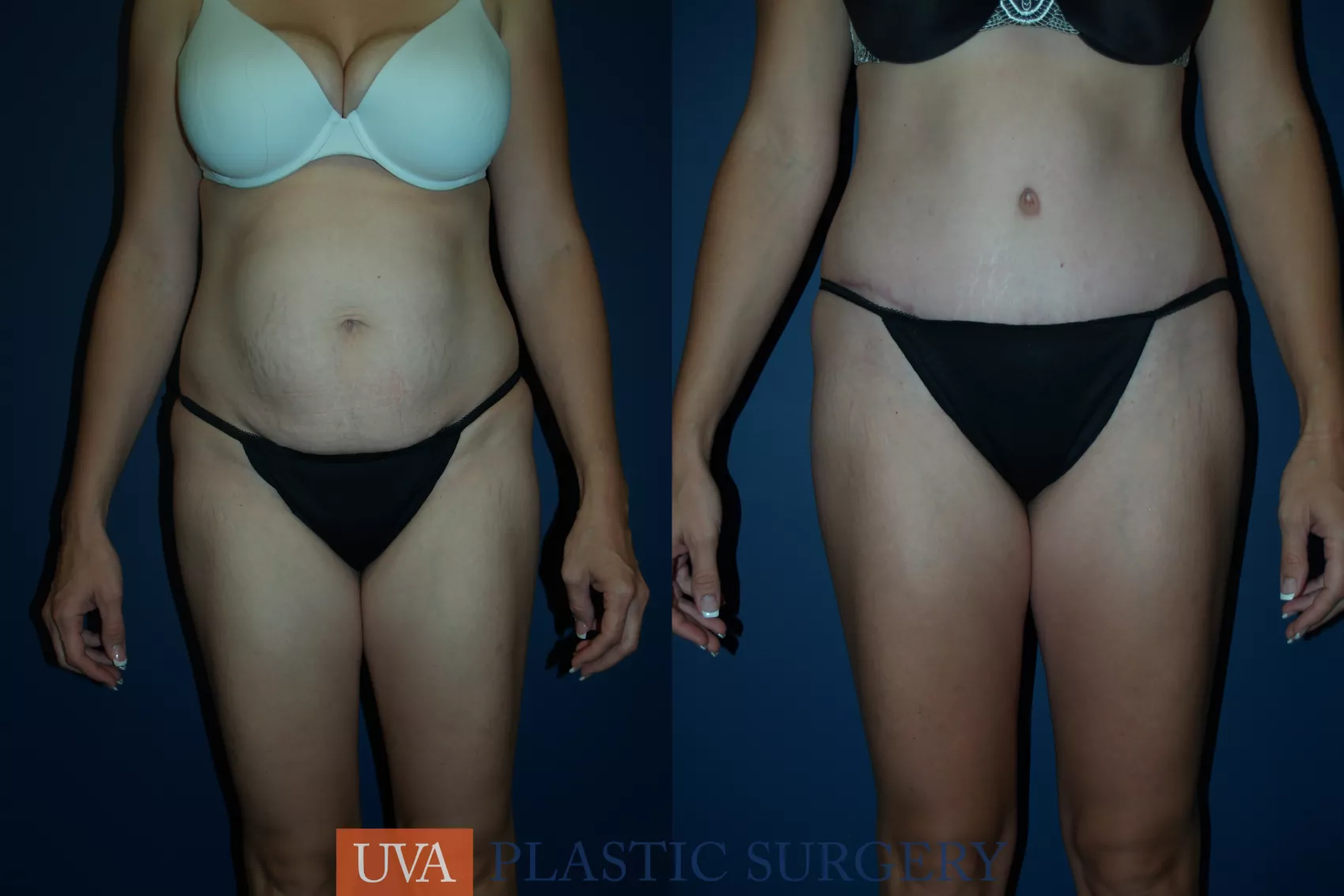 Mommy Makeover Before and After Pictures Case 42 Charlottesville and Fishersville, VA University of Virginia Plastic Surgery