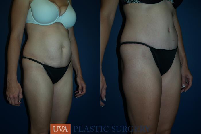Mommy Makeover Case 42 Before & After View #2 | Richmond, Charlottesville & Roanoke, VA | University of Virginia Plastic Surgery