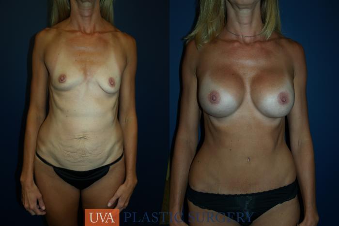 Mommy Makeover Case 58 Before & After View #1 | Richmond, Charlottesville & Roanoke, VA | University of Virginia Plastic Surgery