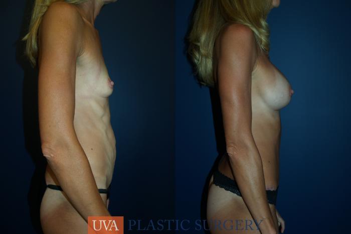 Mommy Makeover Case 58 Before & After View #3 | Richmond, Charlottesville & Roanoke, VA | University of Virginia Plastic Surgery