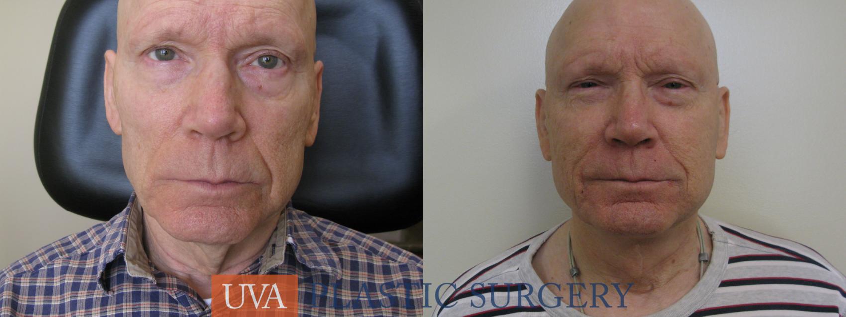 Necklift (Cervicoplasty) Case 114 Before & After View #1 | Richmond, Charlottesville & Roanoke, VA | University of Virginia Plastic Surgery