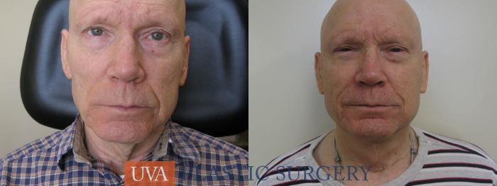 Necklift (Cervicoplasty) Case 114 Before & After View #1 | Charlottesville & Fishersville, VA | University of Virginia Plastic Surgery