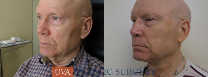 Necklift (Cervicoplasty) Case 114 Before & After View #2 | Richmond, Charlottesville & Roanoke, VA | University of Virginia Plastic Surgery