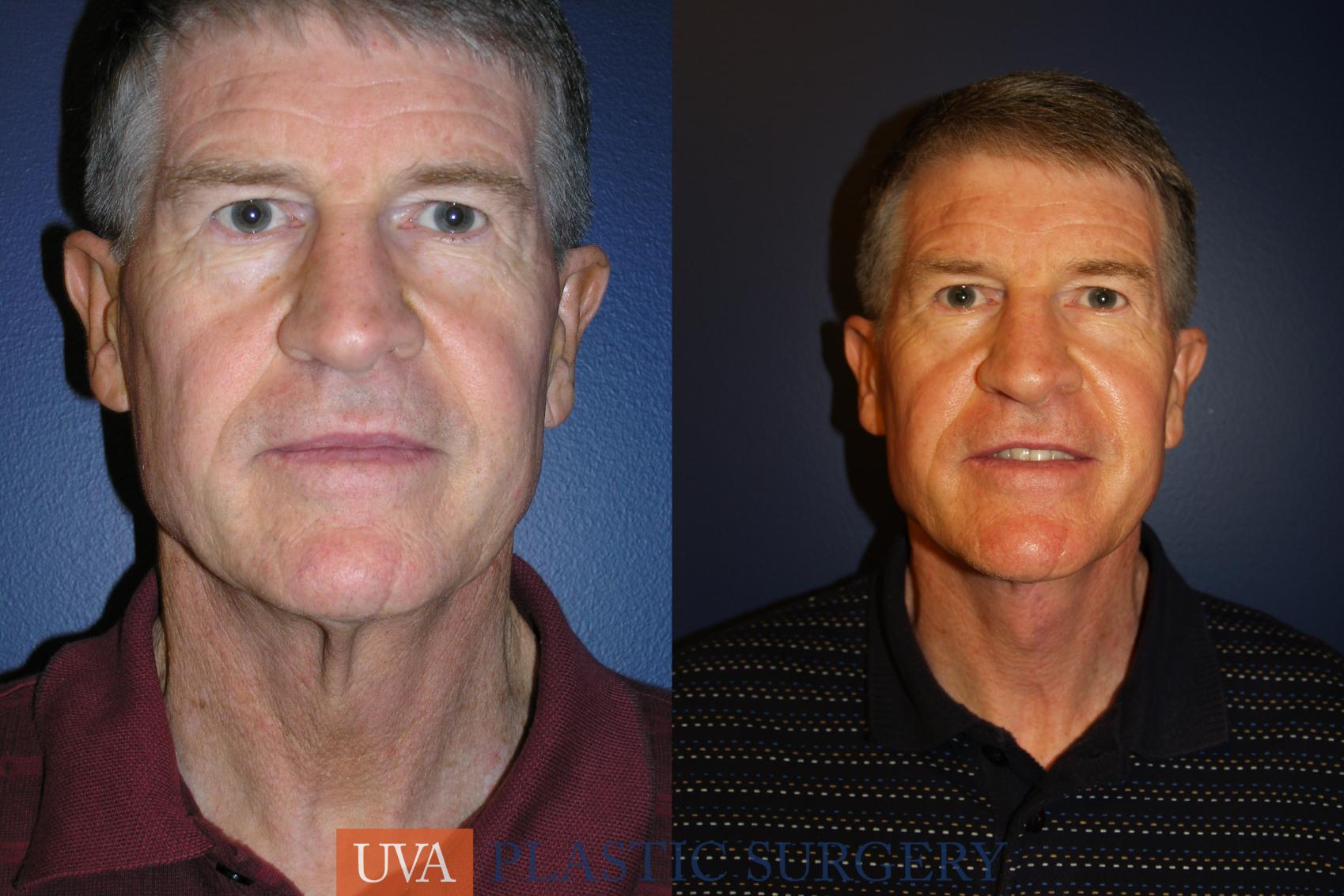 Necklift (Cervicoplasty) Case 12 Before & After View #1 | Richmond, Charlottesville & Roanoke, VA | University of Virginia Plastic Surgery