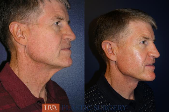 Necklift (Cervicoplasty) Case 12 Before & After View #2 | Richmond, Charlottesville & Roanoke, VA | University of Virginia Plastic Surgery