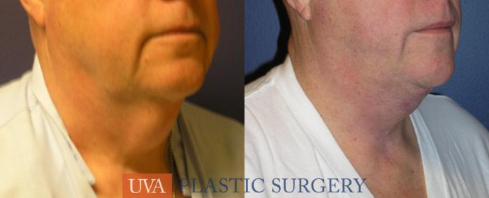 Necklift (Cervicoplasty) Case 15 Before & After View #2 | Richmond, Charlottesville & Roanoke, VA | University of Virginia Plastic Surgery
