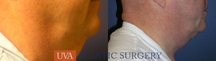 Necklift (Cervicoplasty) Case 15 Before & After View #4 | Richmond, Charlottesville & Roanoke, VA | University of Virginia Plastic Surgery