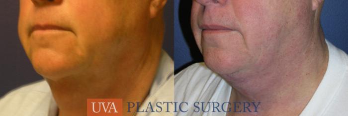 Necklift (Cervicoplasty) Case 15 Before & After View #5 | Richmond, Charlottesville & Roanoke, VA | University of Virginia Plastic Surgery