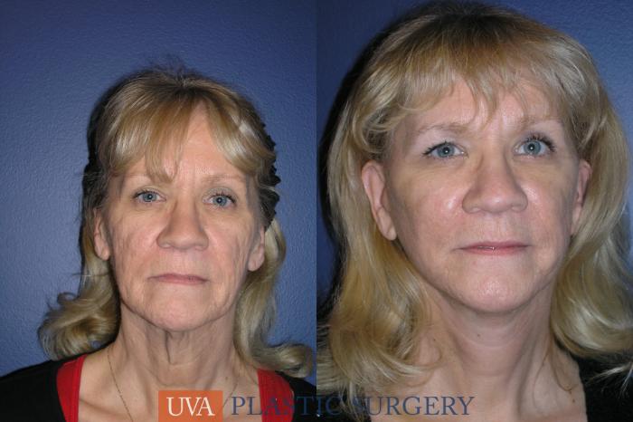 Necklift (Cervicoplasty) Case 19 Before & After View #1 | Charlottesville & Fishersville, VA | University of Virginia Plastic Surgery