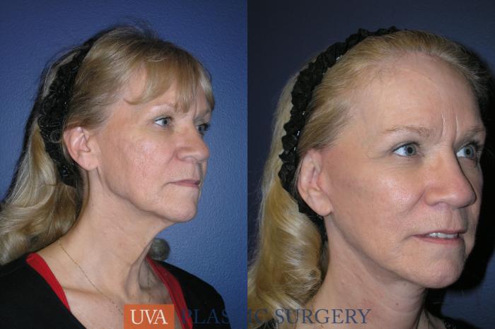 Necklift (Cervicoplasty) Case 19 Before & After View #2 | Charlottesville & Fishersville, VA | University of Virginia Plastic Surgery