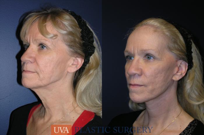 Necklift (Cervicoplasty) Case 19 Before & After View #3 | Charlottesville & Fishersville, VA | University of Virginia Plastic Surgery