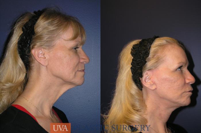Necklift (Cervicoplasty) Case 19 Before & After View #4 | Charlottesville & Fishersville, VA | University of Virginia Plastic Surgery