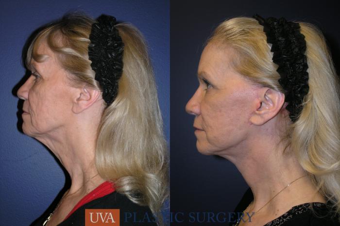 Necklift (Cervicoplasty) Case 19 Before & After View #5 | Charlottesville & Fishersville, VA | University of Virginia Plastic Surgery