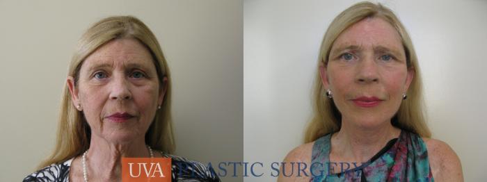 Necklift (Cervicoplasty) Case 80 Before & After View #1 | Charlottesville & Fishersville, VA | University of Virginia Plastic Surgery