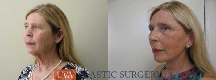 Necklift (Cervicoplasty) Case 80 Before & After View #4 | Charlottesville & Fishersville, VA | University of Virginia Plastic Surgery