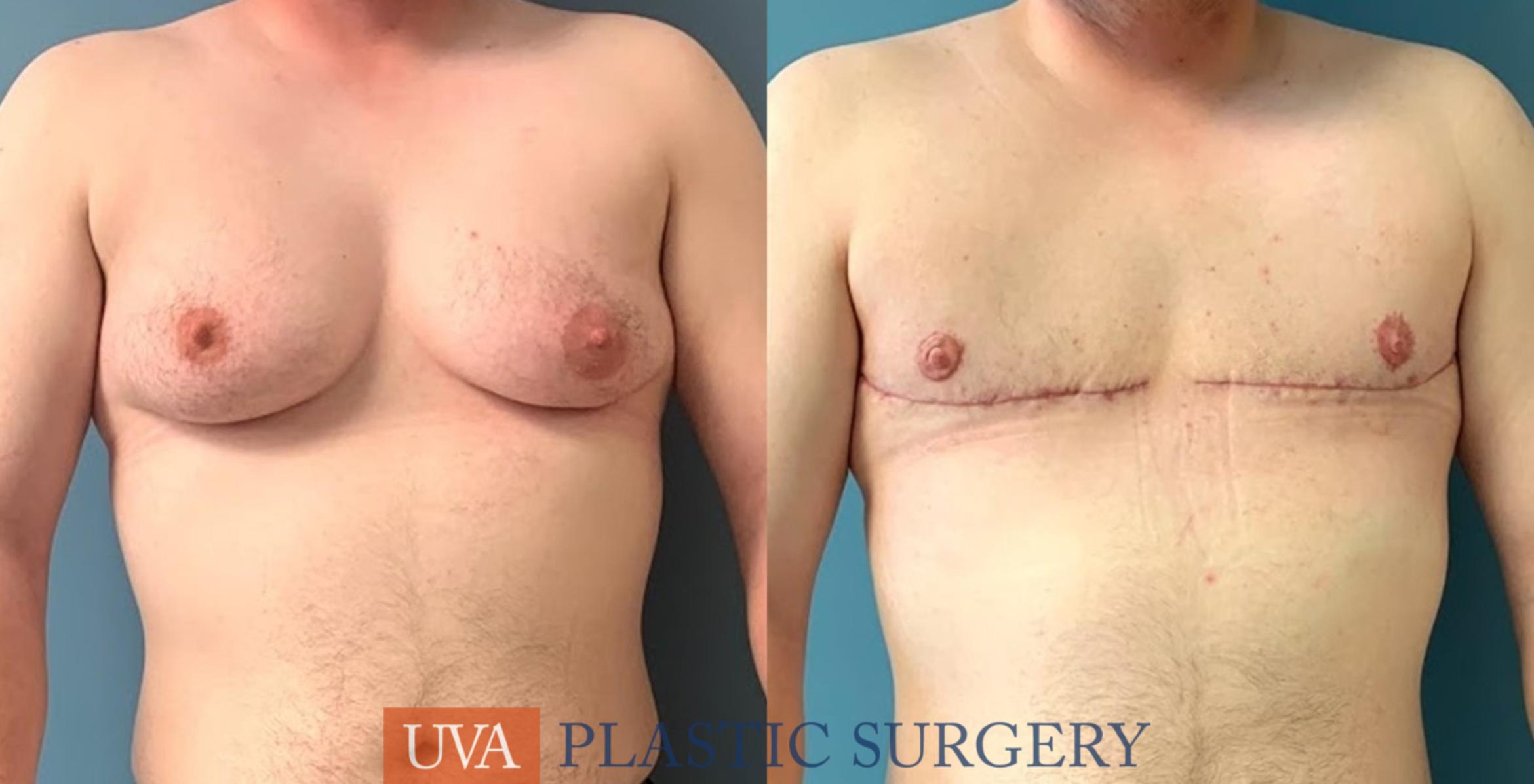 Top Surgery Case 230 Before & After Front | Charlottesville & Fishersville, VA | University of Virginia Plastic Surgery