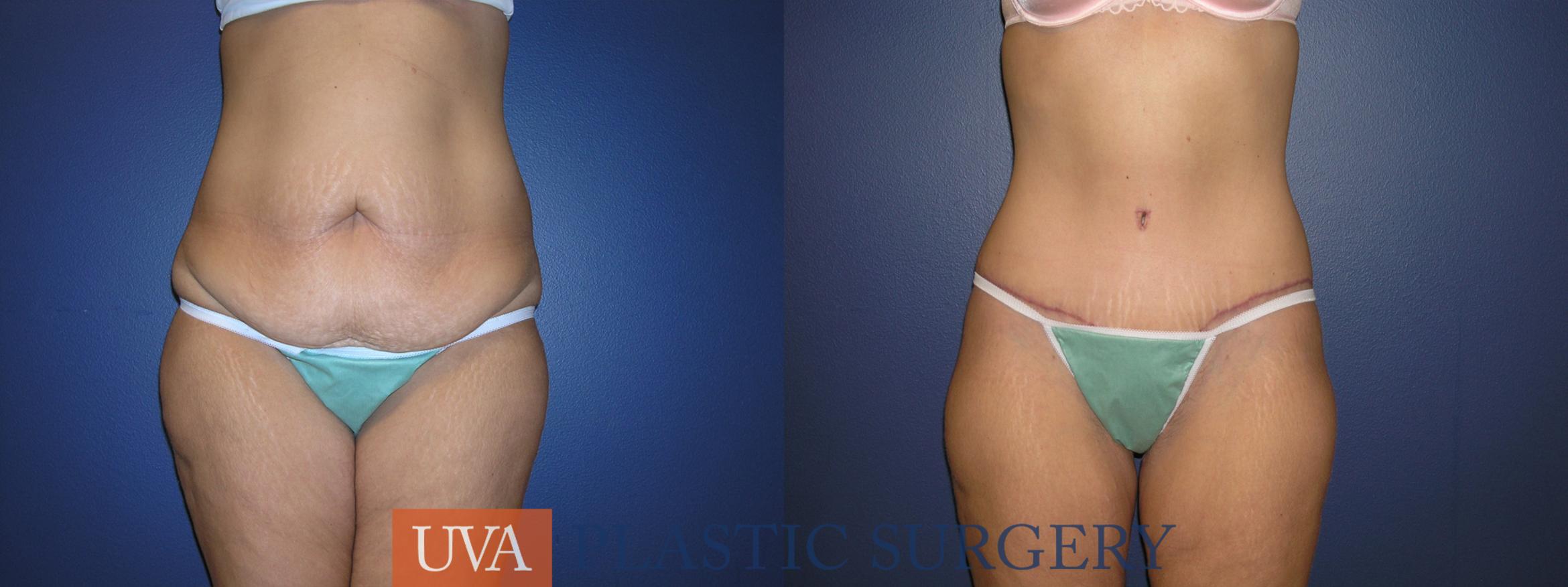 Tummy Tuck (Abdominoplasty) Case 222 Before & After View #1 | Charlottesville & Fishersville, VA | University of Virginia Plastic Surgery