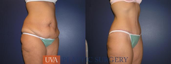 Tummy Tuck (Abdominoplasty) Case 222 Before & After View #4 | Richmond, Charlottesville & Roanoke, VA | University of Virginia Plastic Surgery