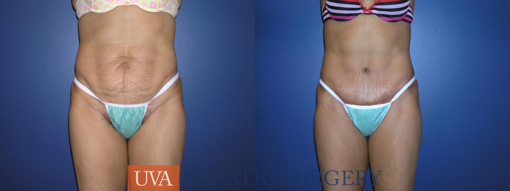 Tummy Tuck (Abdominoplasty) Case 31 Before & After View #1 | Charlottesville & Fishersville, VA | University of Virginia Plastic Surgery