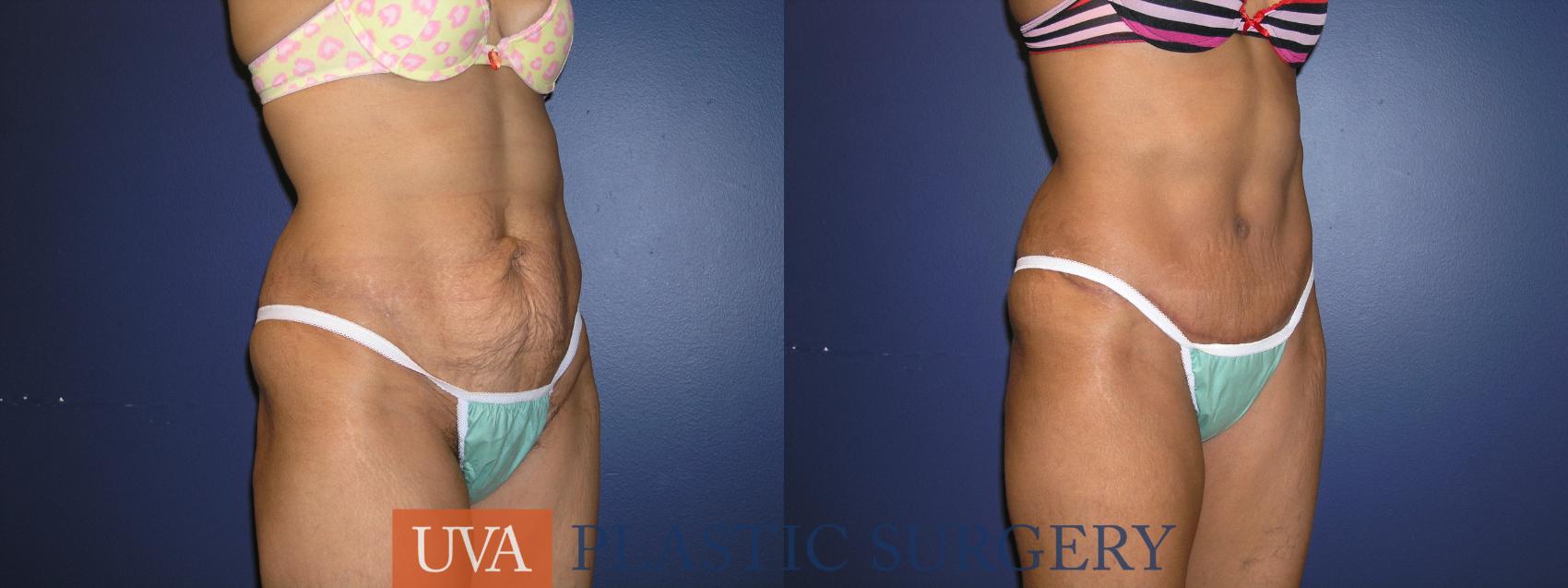Tummy Tuck (Abdominoplasty) Case 31 Before & After View #2 | Charlottesville & Fishersville, VA | University of Virginia Plastic Surgery