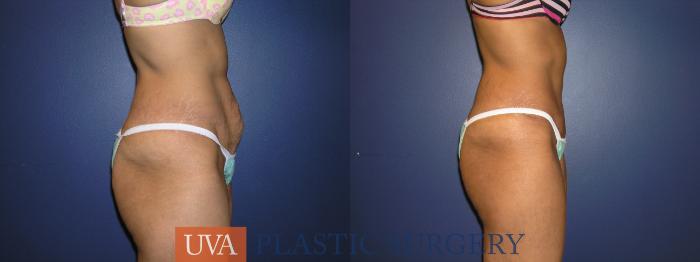 Tummy Tuck (Abdominoplasty) Case 31 Before & After View #4 | Richmond, Charlottesville & Roanoke, VA | University of Virginia Plastic Surgery