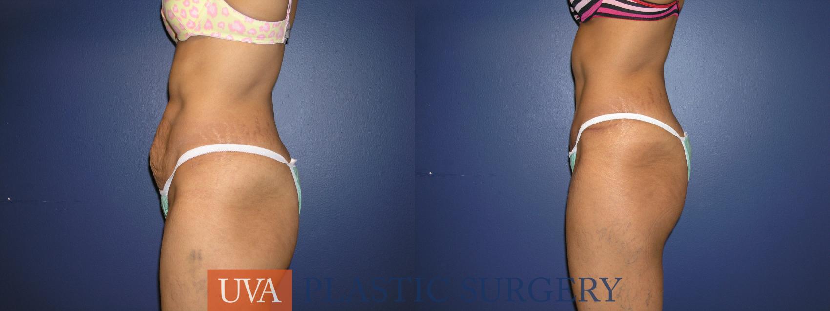 Tummy Tuck (Abdominoplasty) Case 31 Before & After View #5 | Charlottesville & Fishersville, VA | University of Virginia Plastic Surgery