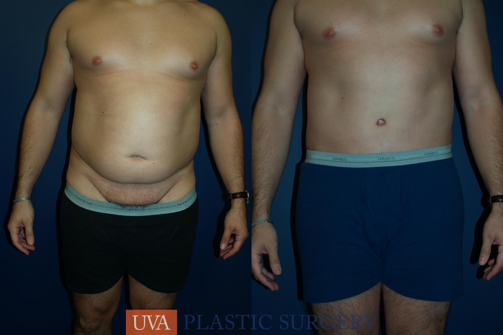 Tummy Tuck (Abdominoplasty) Case 35 Before & After View #1 | Charlottesville & Fishersville, VA | University of Virginia Plastic Surgery