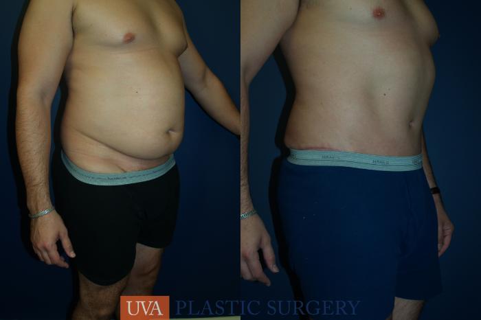 Tummy Tuck (Abdominoplasty) Case 35 Before & After View #2 | Richmond, Charlottesville & Roanoke, VA | University of Virginia Plastic Surgery