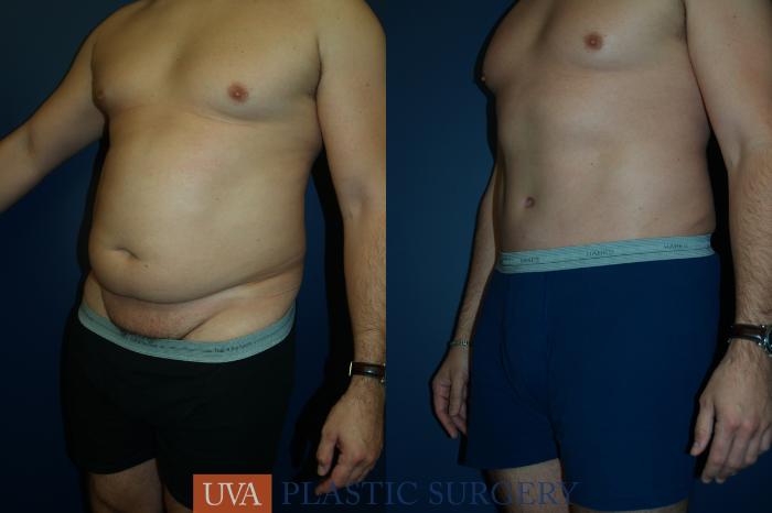 Tummy Tuck (Abdominoplasty) Case 35 Before & After View #3 | Richmond, Charlottesville & Roanoke, VA | University of Virginia Plastic Surgery