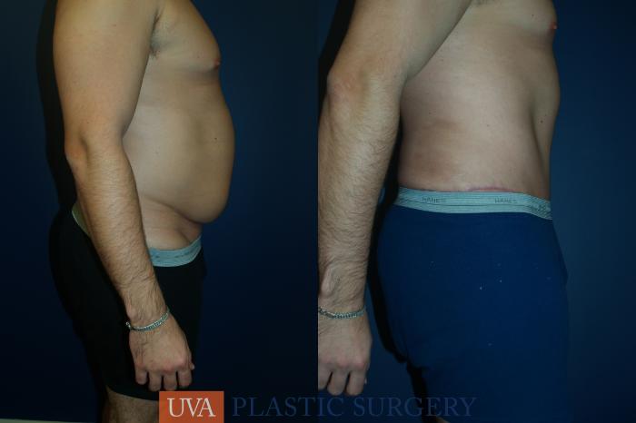 Tummy Tuck (Abdominoplasty) Case 35 Before & After View #4 | Charlottesville & Fishersville, VA | University of Virginia Plastic Surgery