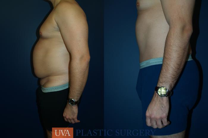 Tummy Tuck (Abdominoplasty) Case 35 Before & After View #5 | Richmond, Charlottesville & Roanoke, VA | University of Virginia Plastic Surgery