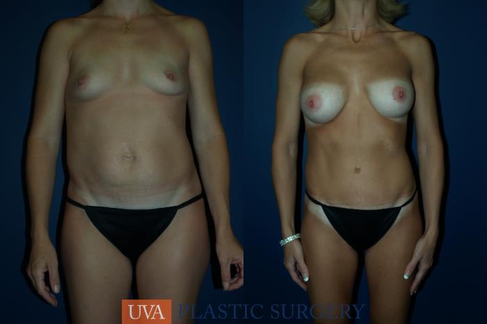 Tummy Tuck (Abdominoplasty) Case 61 Before & After View #1 | Richmond, Charlottesville & Roanoke, VA | University of Virginia Plastic Surgery