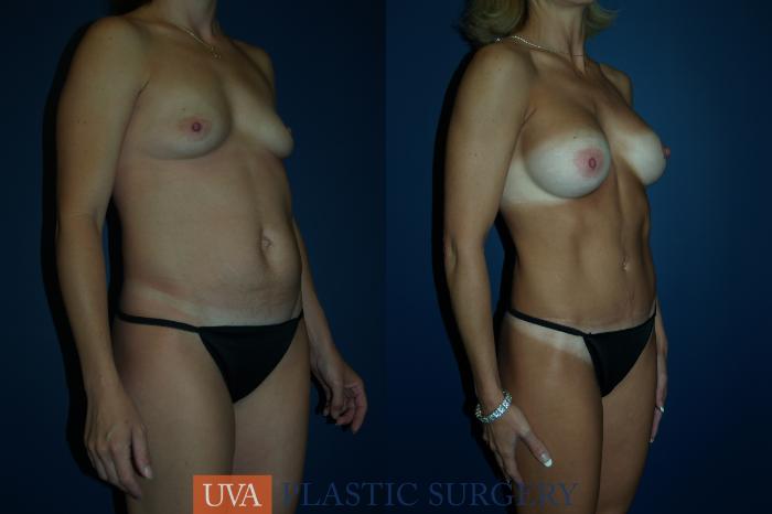 Tummy Tuck (Abdominoplasty) Case 61 Before & After View #2 | Richmond, Charlottesville & Roanoke, VA | University of Virginia Plastic Surgery