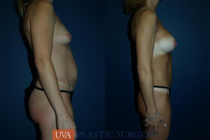 Tummy Tuck (Abdominoplasty) Case 61 Before & After View #3 | Richmond, Charlottesville & Roanoke, VA | University of Virginia Plastic Surgery