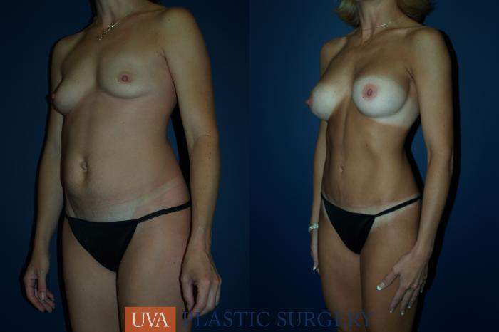 Tummy Tuck (Abdominoplasty) Case 61 Before & After View #4 | Richmond, Charlottesville & Roanoke, VA | University of Virginia Plastic Surgery