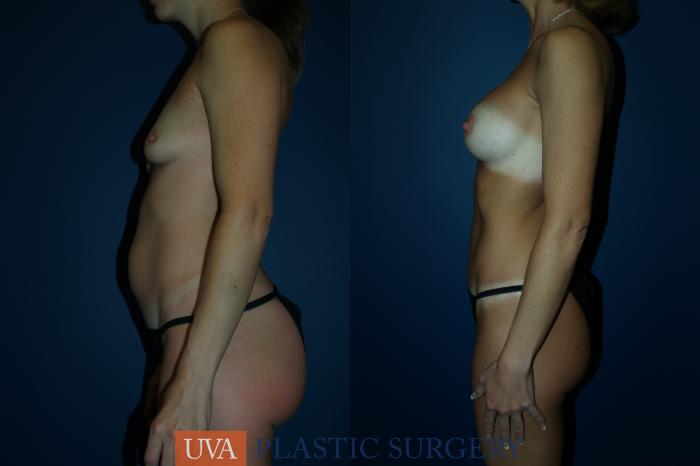 Tummy Tuck (Abdominoplasty) Case 61 Before & After View #5 | Richmond, Charlottesville & Roanoke, VA | University of Virginia Plastic Surgery