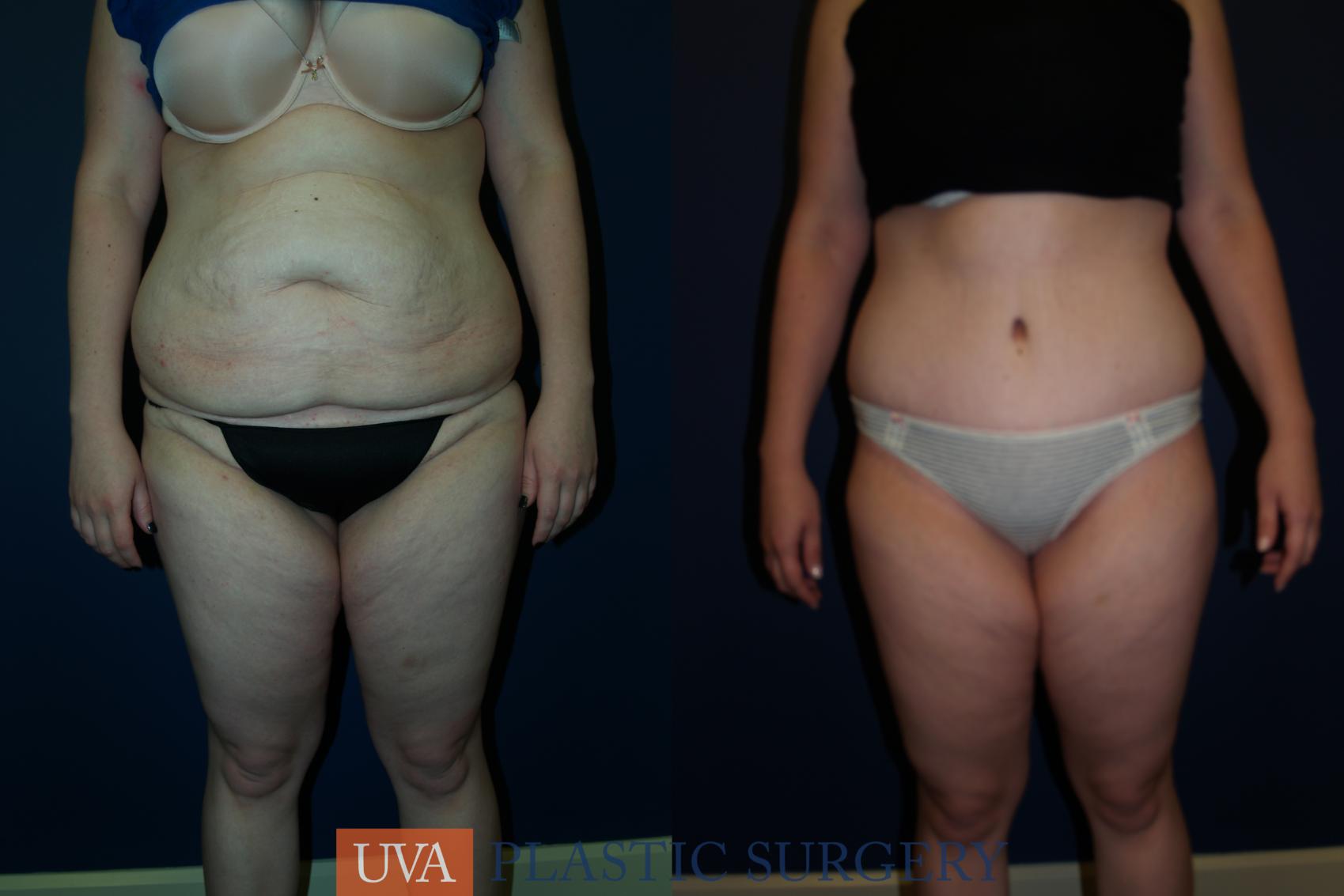 Tummy Tuck (Abdominoplasty) Case 67 Before & After View #1 | Charlottesville & Fishersville, VA | University of Virginia Plastic Surgery