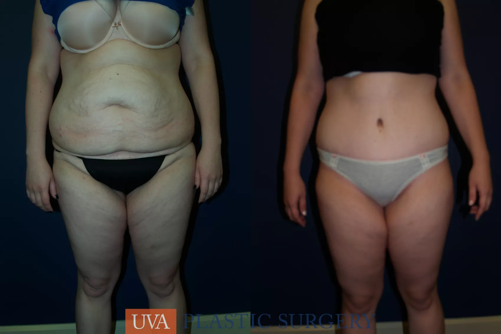 Tummy Tuck (Abdominoplasty) Before and After Pictures Case 66, Gilbert, AZ