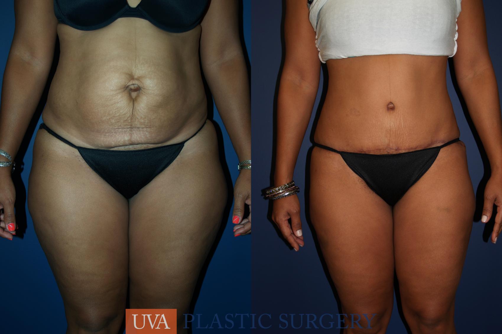Tummy Tuck (Abdominoplasty) Case 68 Before & After View #1 | Charlottesville & Fishersville, VA | University of Virginia Plastic Surgery