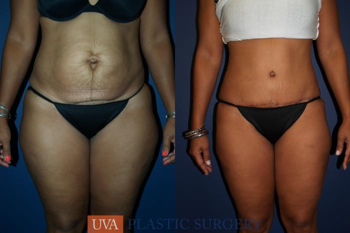 Tummy Tuck (Abdominoplasty) Case 68 Before & After View #1 | Richmond, Charlottesville & Roanoke, VA | University of Virginia Plastic Surgery