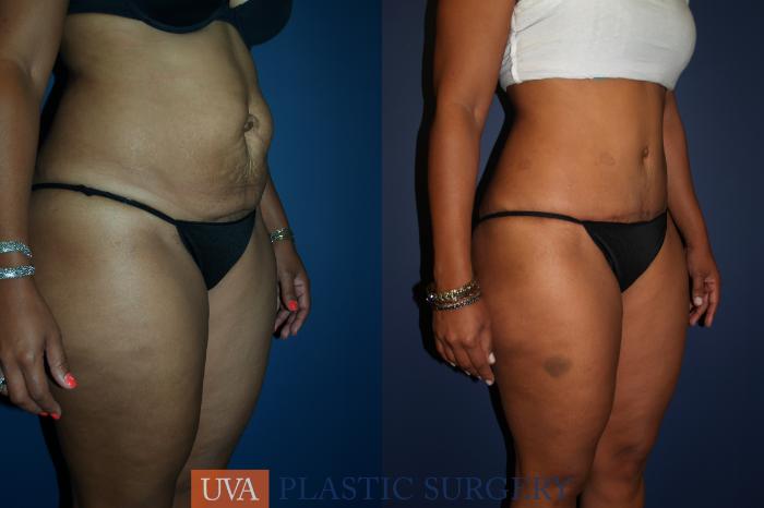 Tummy Tuck (Abdominoplasty) Case 68 Before & After View #2 | Richmond, Charlottesville & Roanoke, VA | University of Virginia Plastic Surgery
