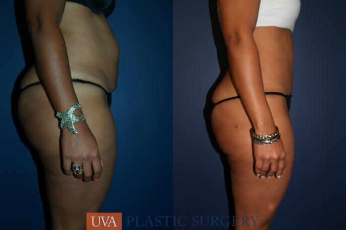 Tummy Tuck (Abdominoplasty) Case 68 Before & After View #3 | Richmond, Charlottesville & Roanoke, VA | University of Virginia Plastic Surgery